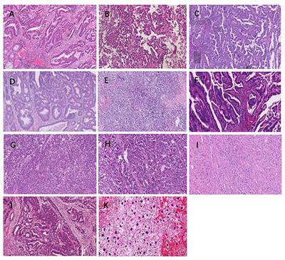 Non-classical phenotypes of mismatch repair deficiency and microsatellite instability in primary and metastatic tumors at different sites in Lynch syndrome